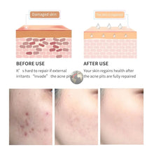 Acne Scar Removal Gel Tea - Mode Fashion